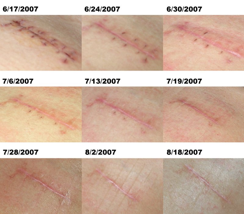 wound-progression