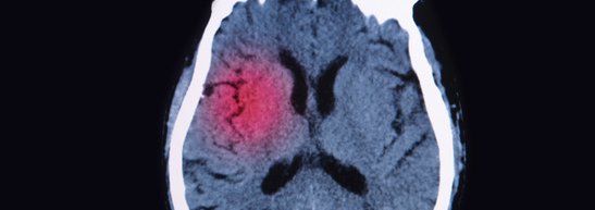 Ohio Supreme Court Ruled That It May Count Cte As A Latent Disease In Recent Case That Was Filed Critchett Law