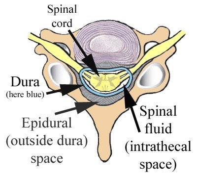 epidural injection