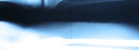 X-ray of leg bones